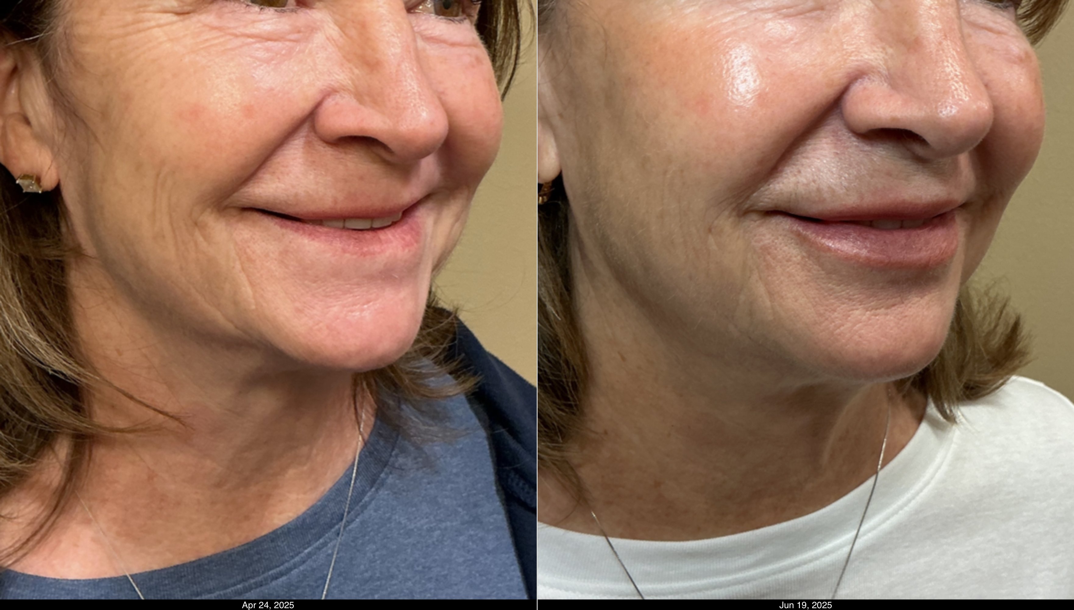 SkinVive and Restylane Kysse (5)