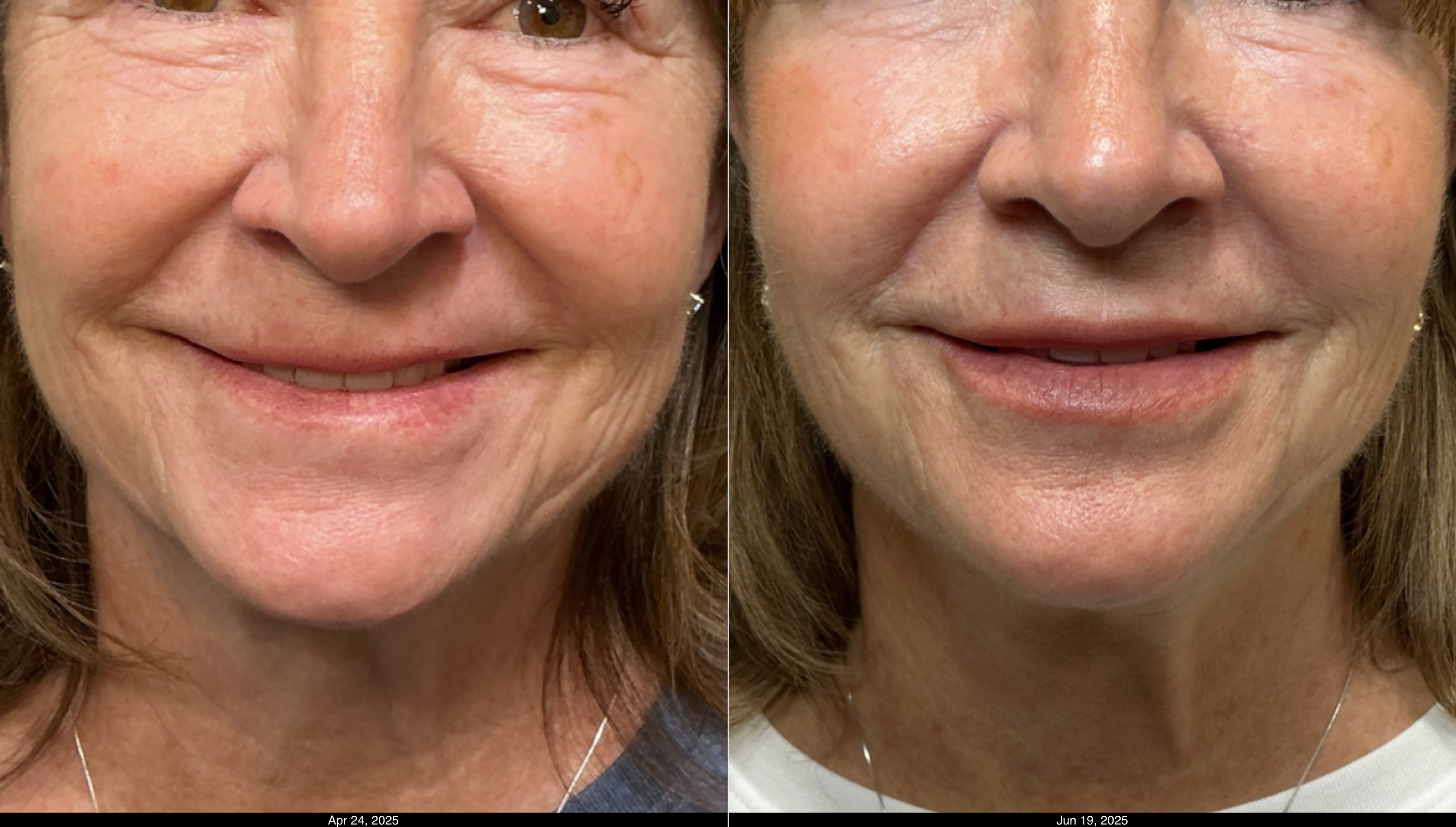 SkinVive and Restylane Kysse (6)