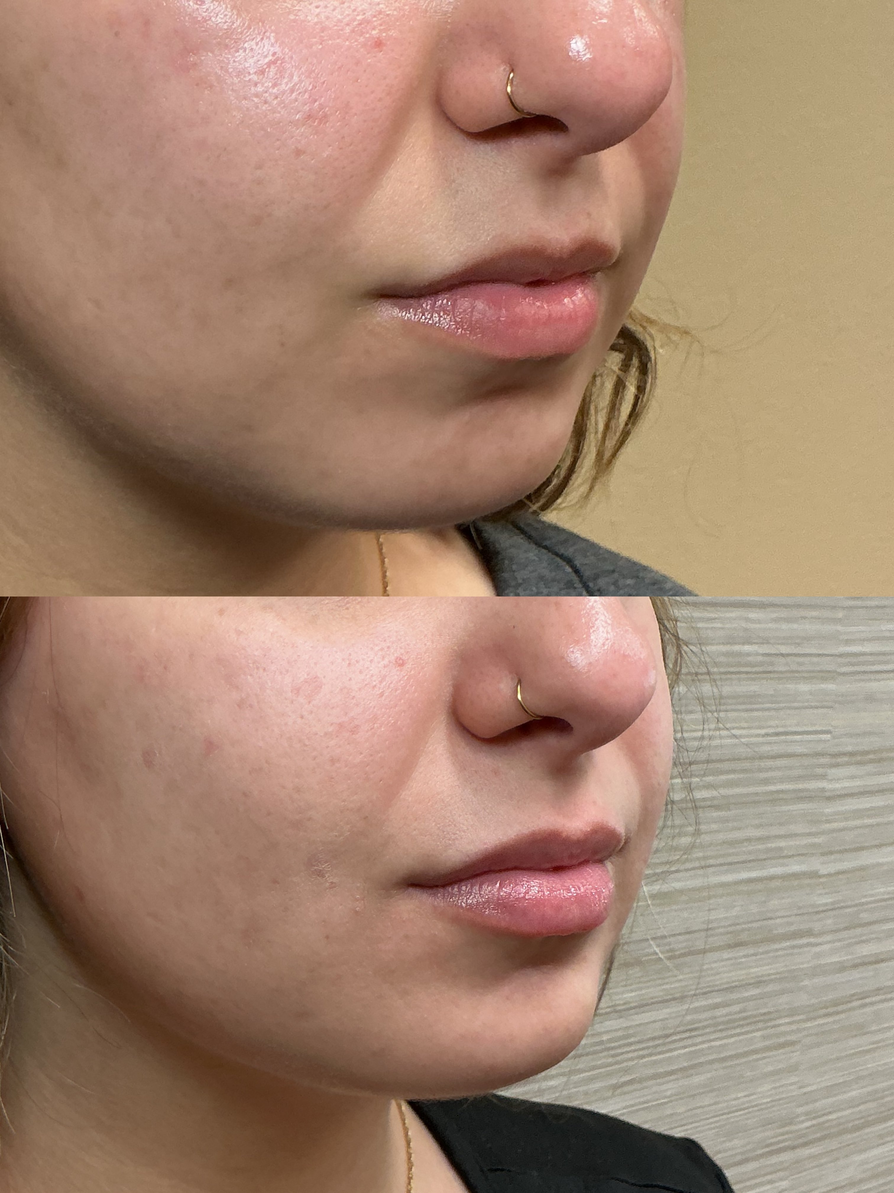 Ultra half syringe (1)