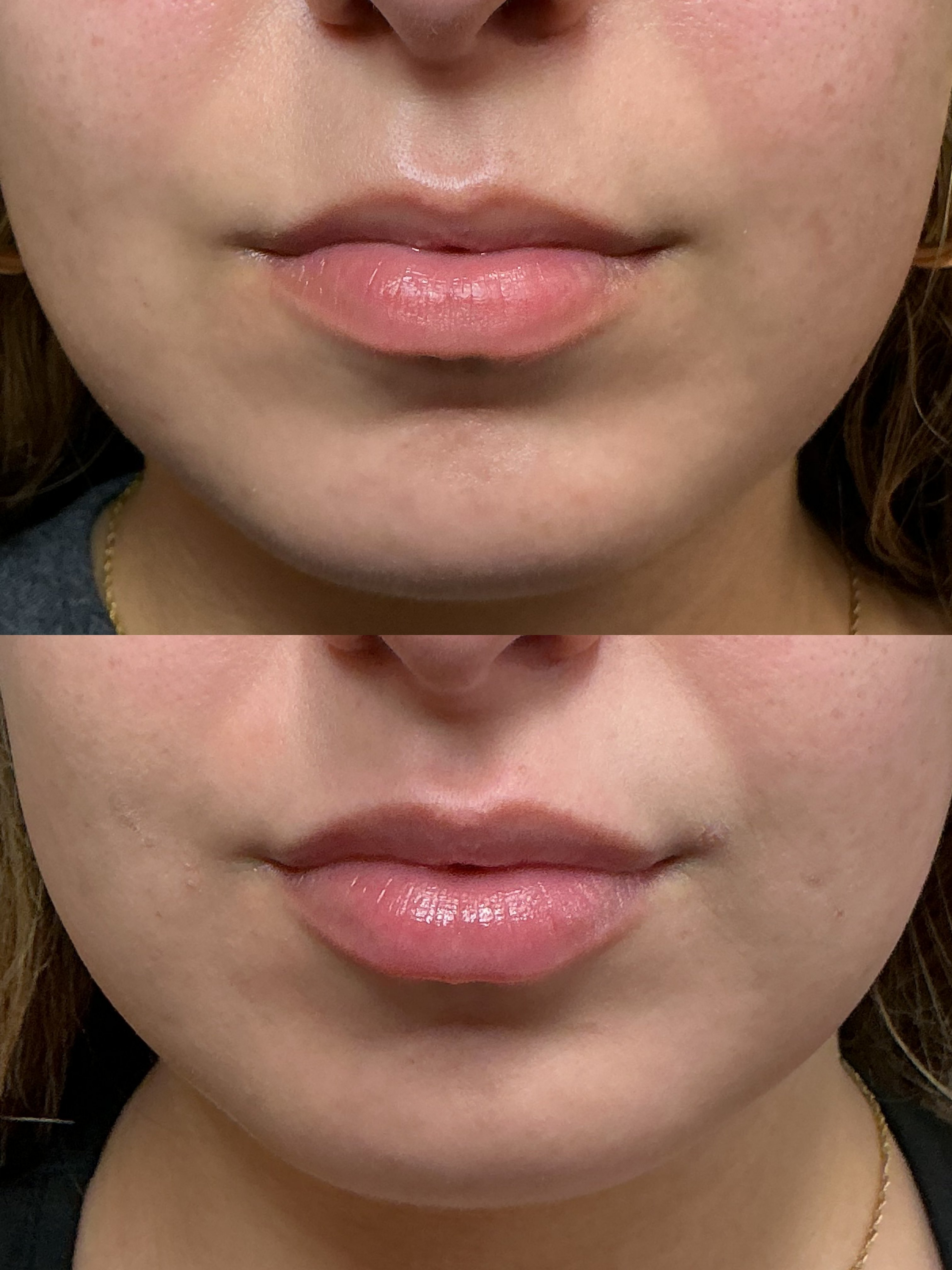 Ultra half syringe (2)