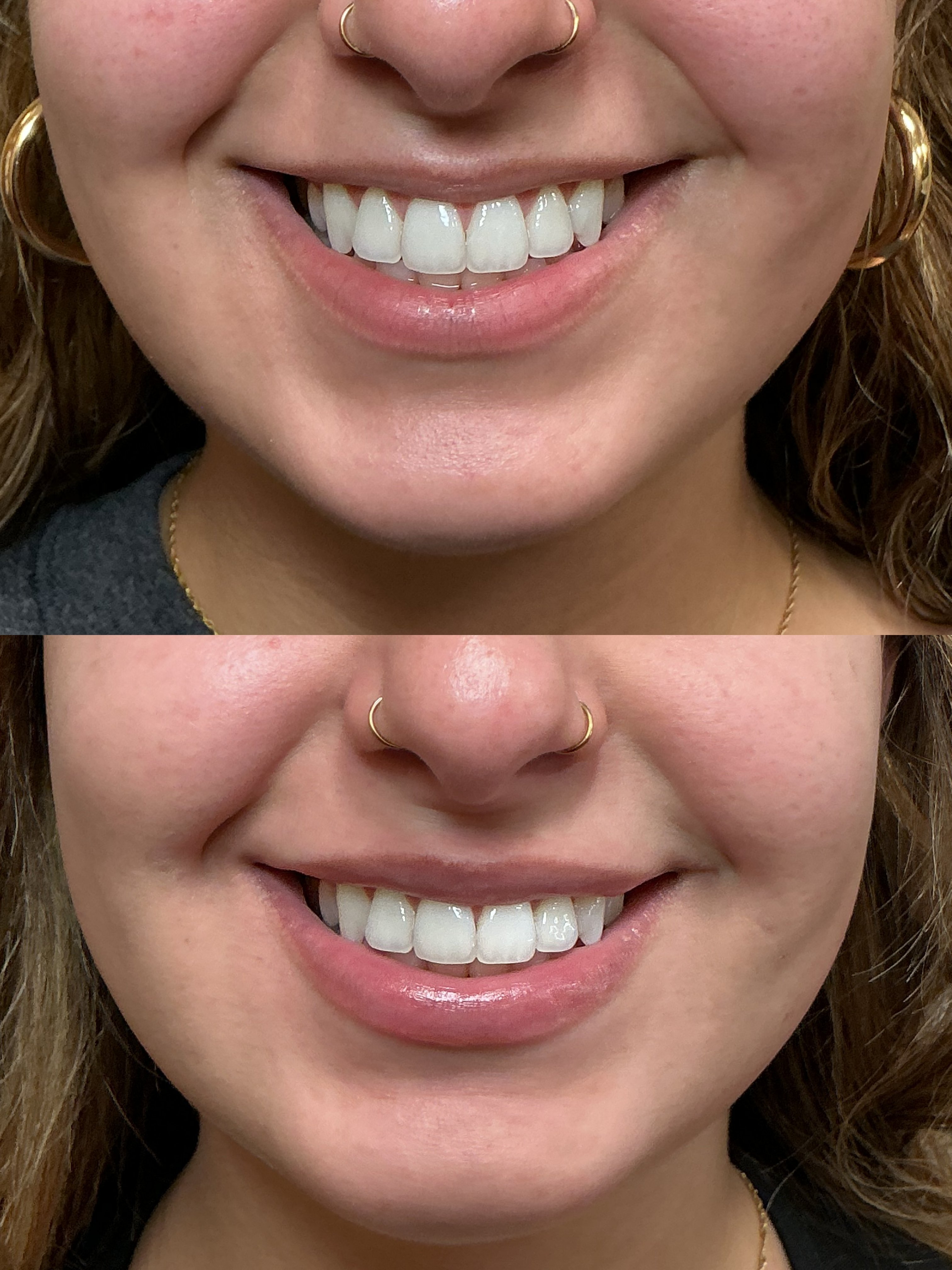 Ultra half syringe (3)