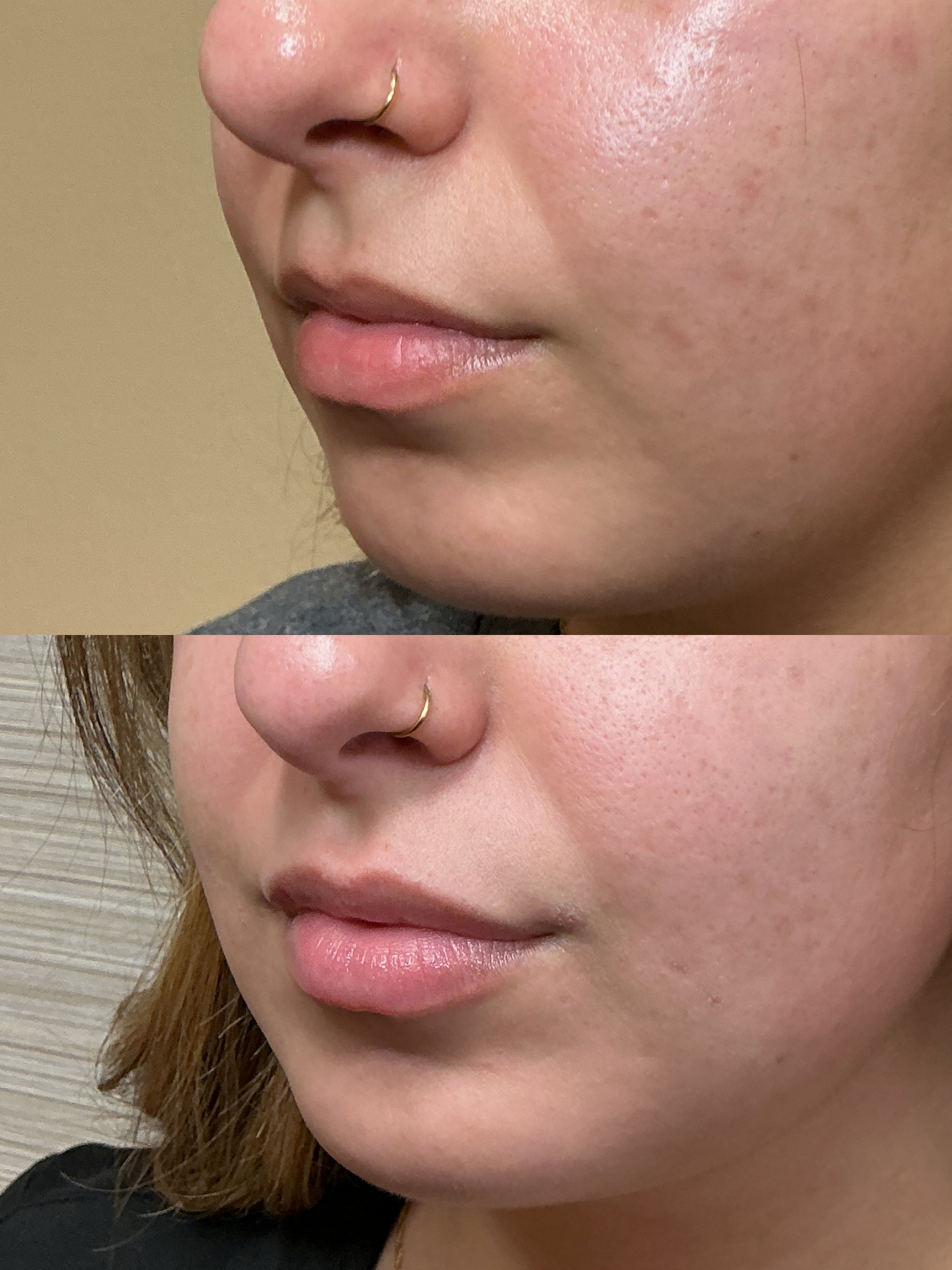 Ultra half syringe (4)