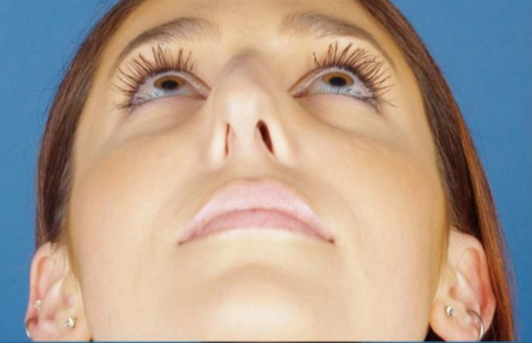 7 Symptoms of a Deviated Septum & How Surgery Might Help