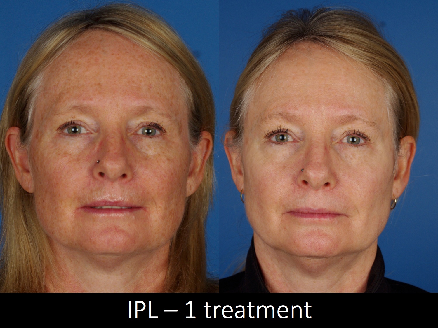 facial treatments-112-1 of 2