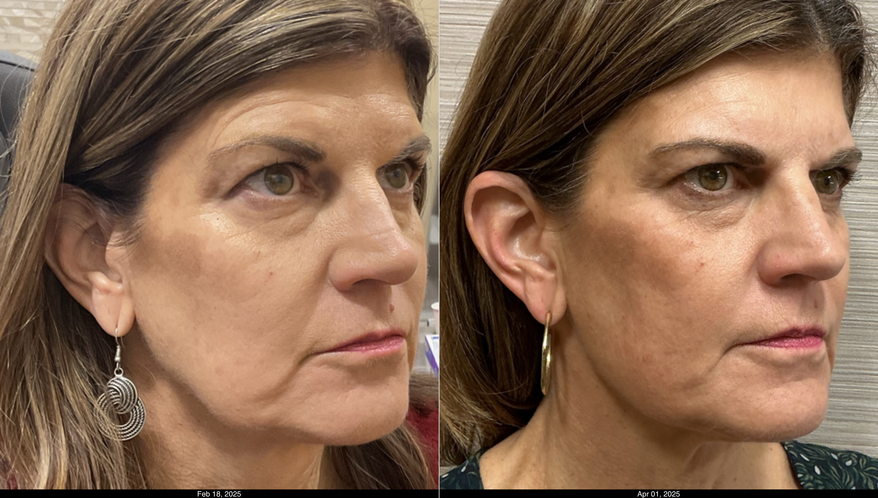 filler PJ, MLF, jawline and submalars (1)