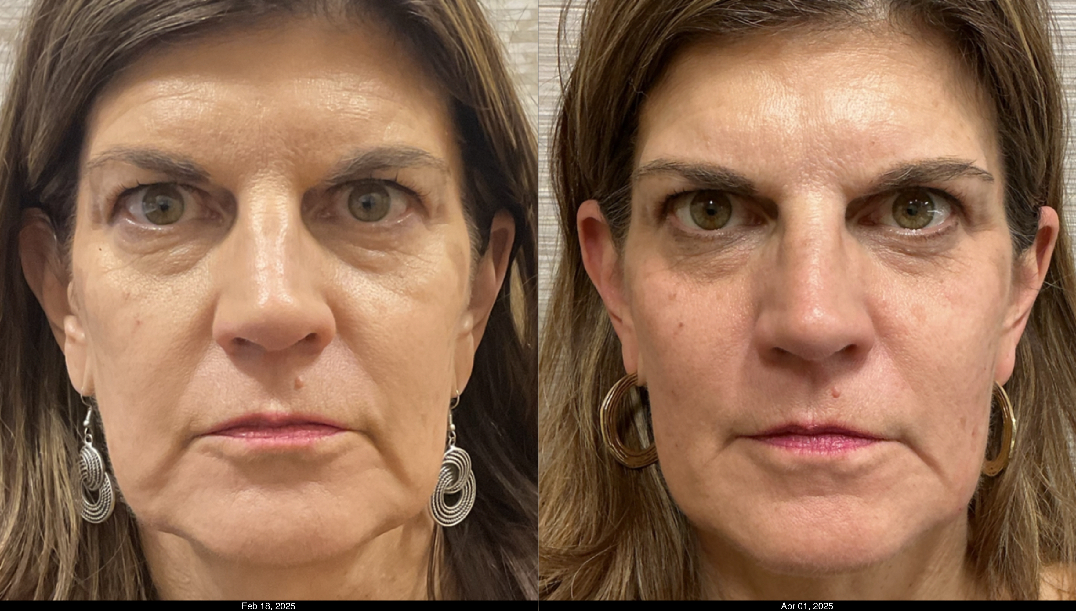 filler PJ, MLF, jawline and submalars (2)