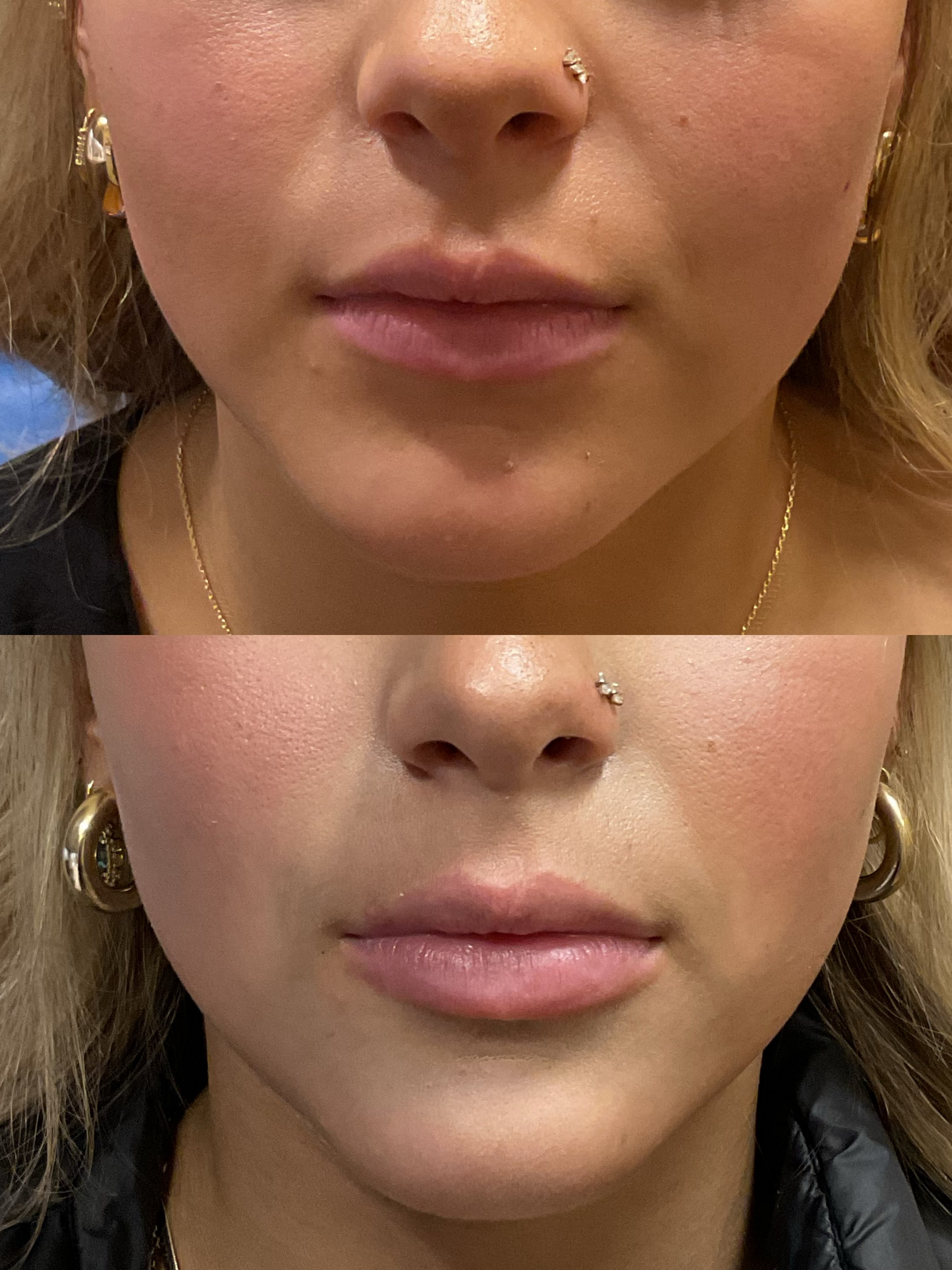filler lips 0.5cc