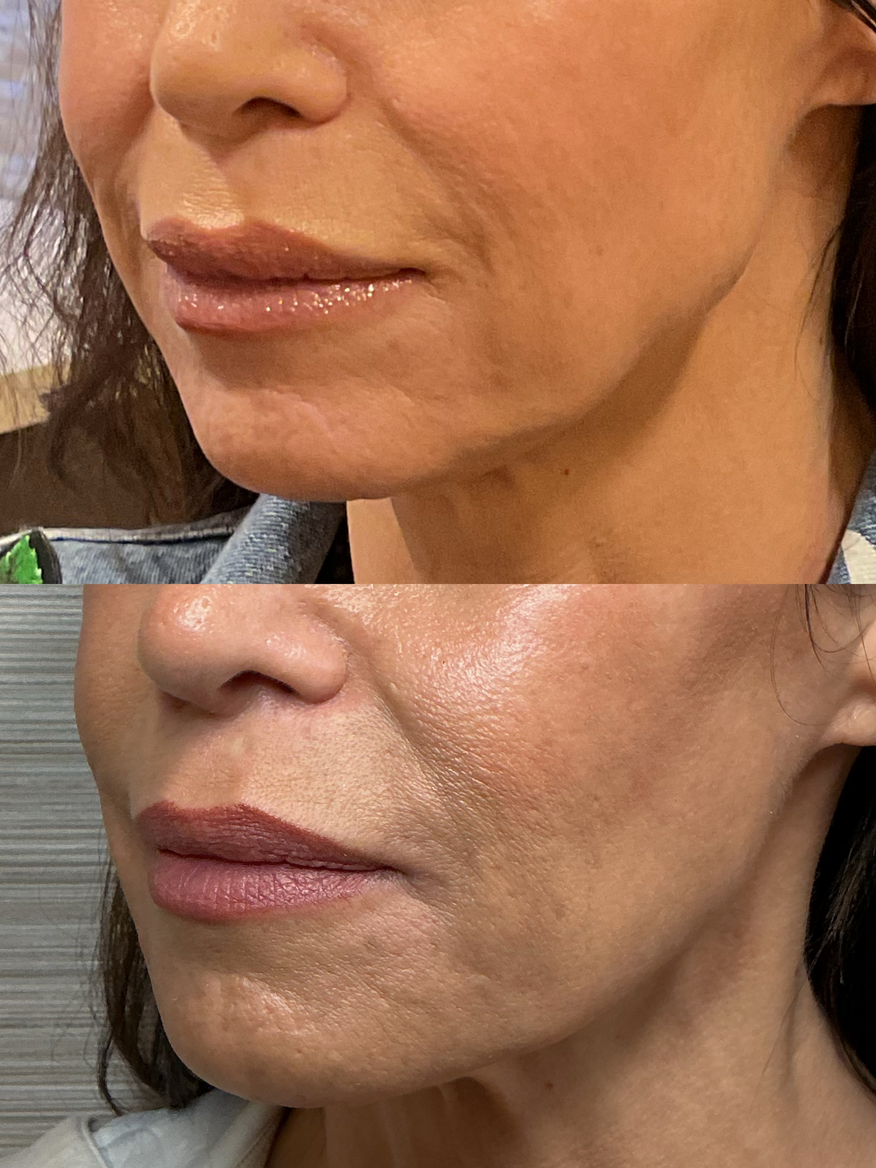 jawline-mlfs-pj-chin-submalars (2)