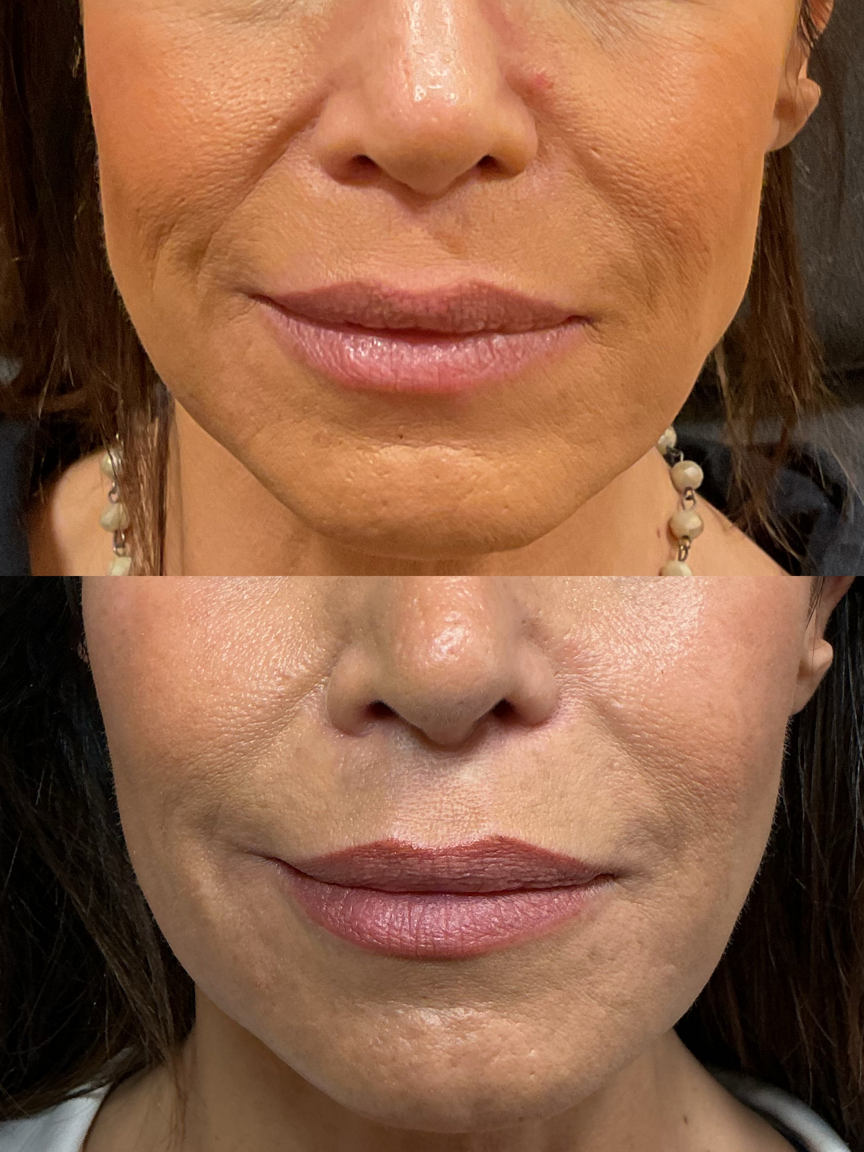 jawline-mlfs-pj-chin-submalars (3)