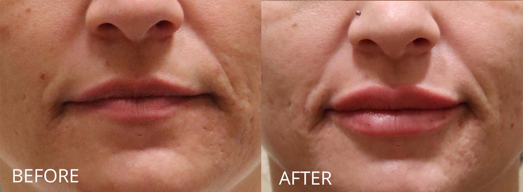 botox-filler-145-1 of 1