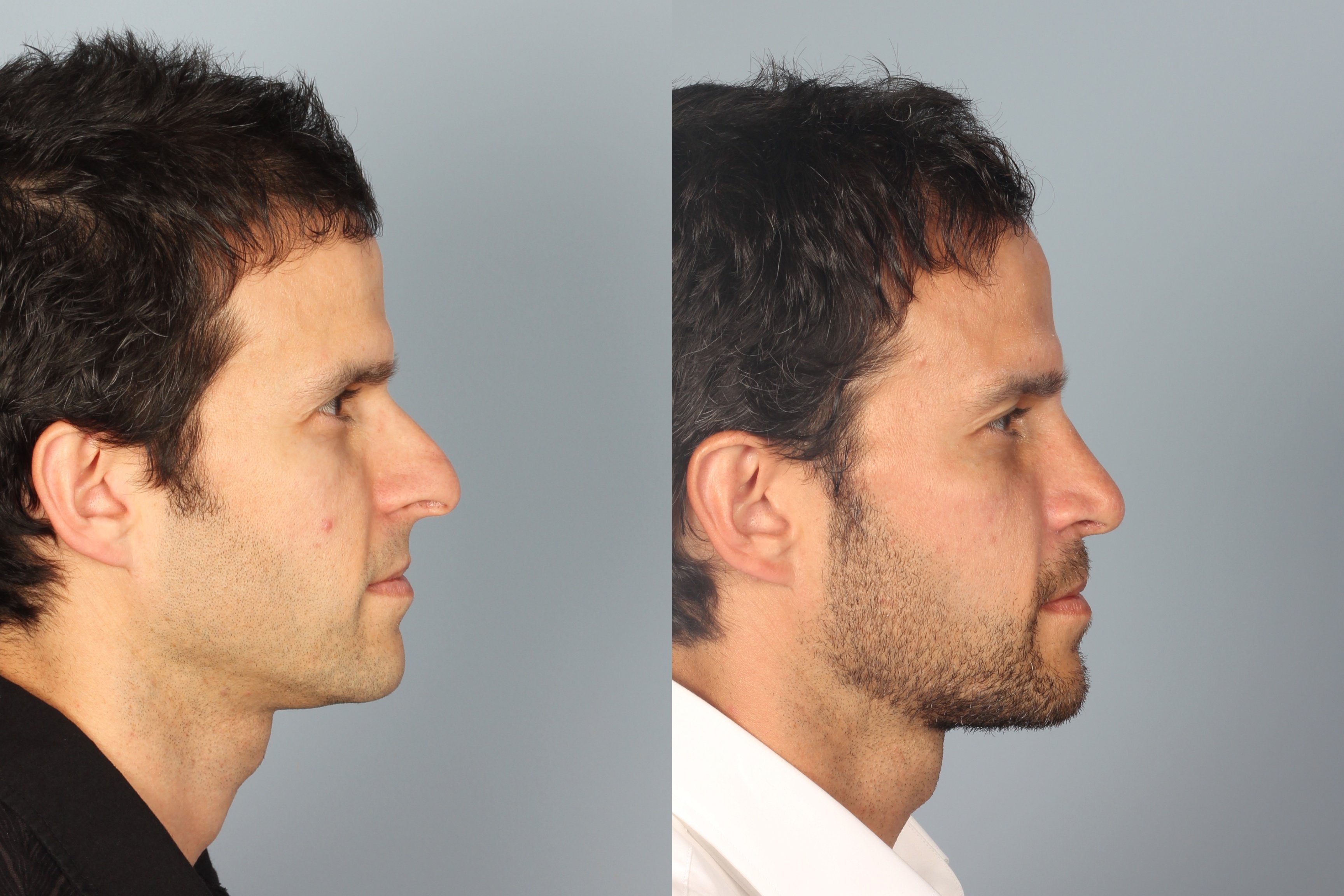 Trends in Rhinoplasty