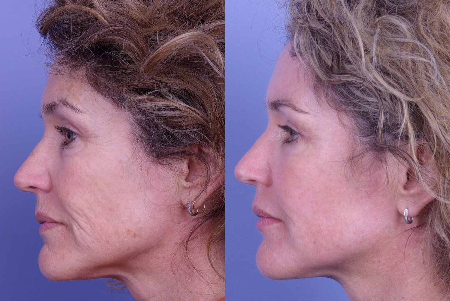 botox-filler-114-1 of 1