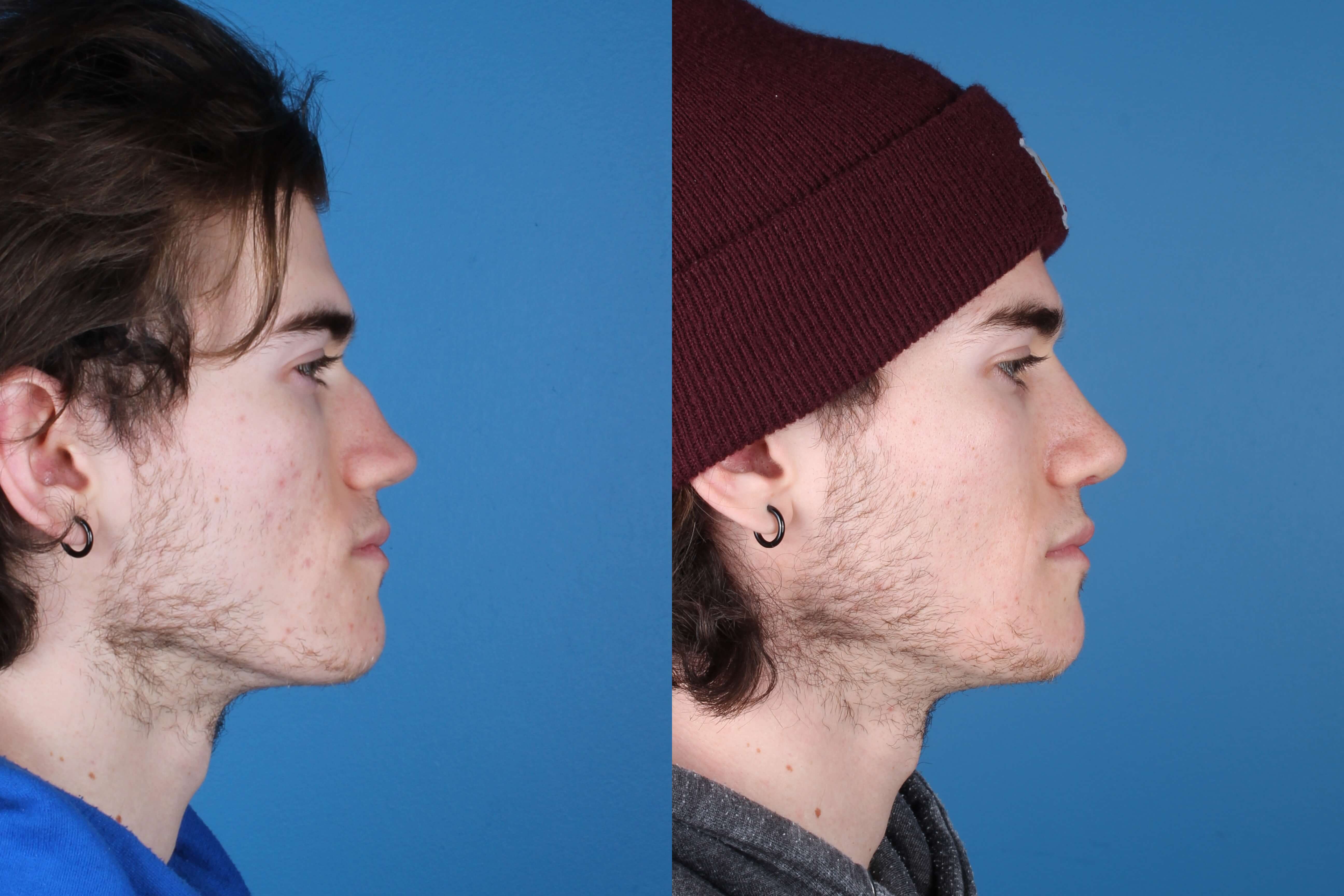 rhinoplasty-330-3 of 5