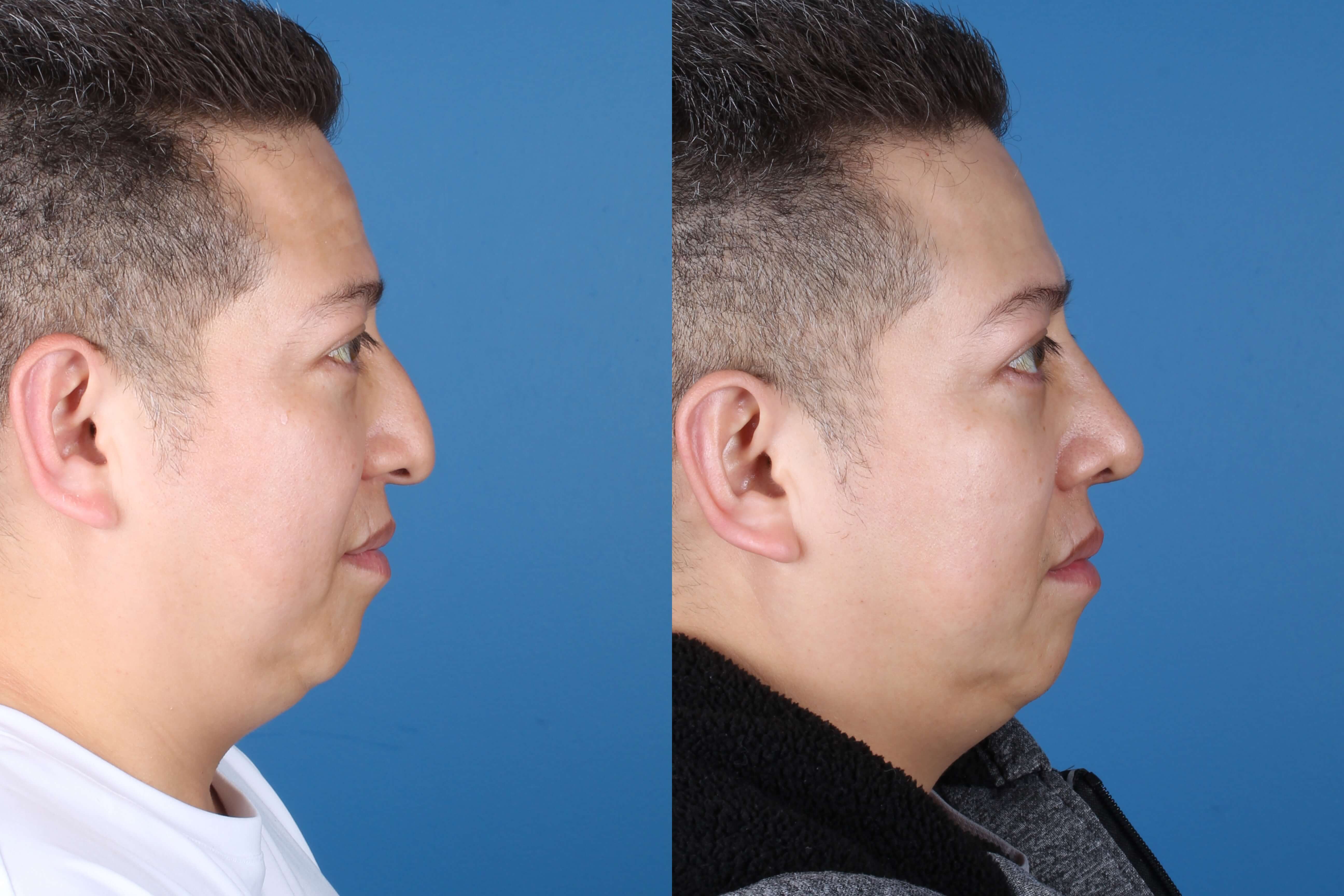 rhinoplasty-331-1 of 5