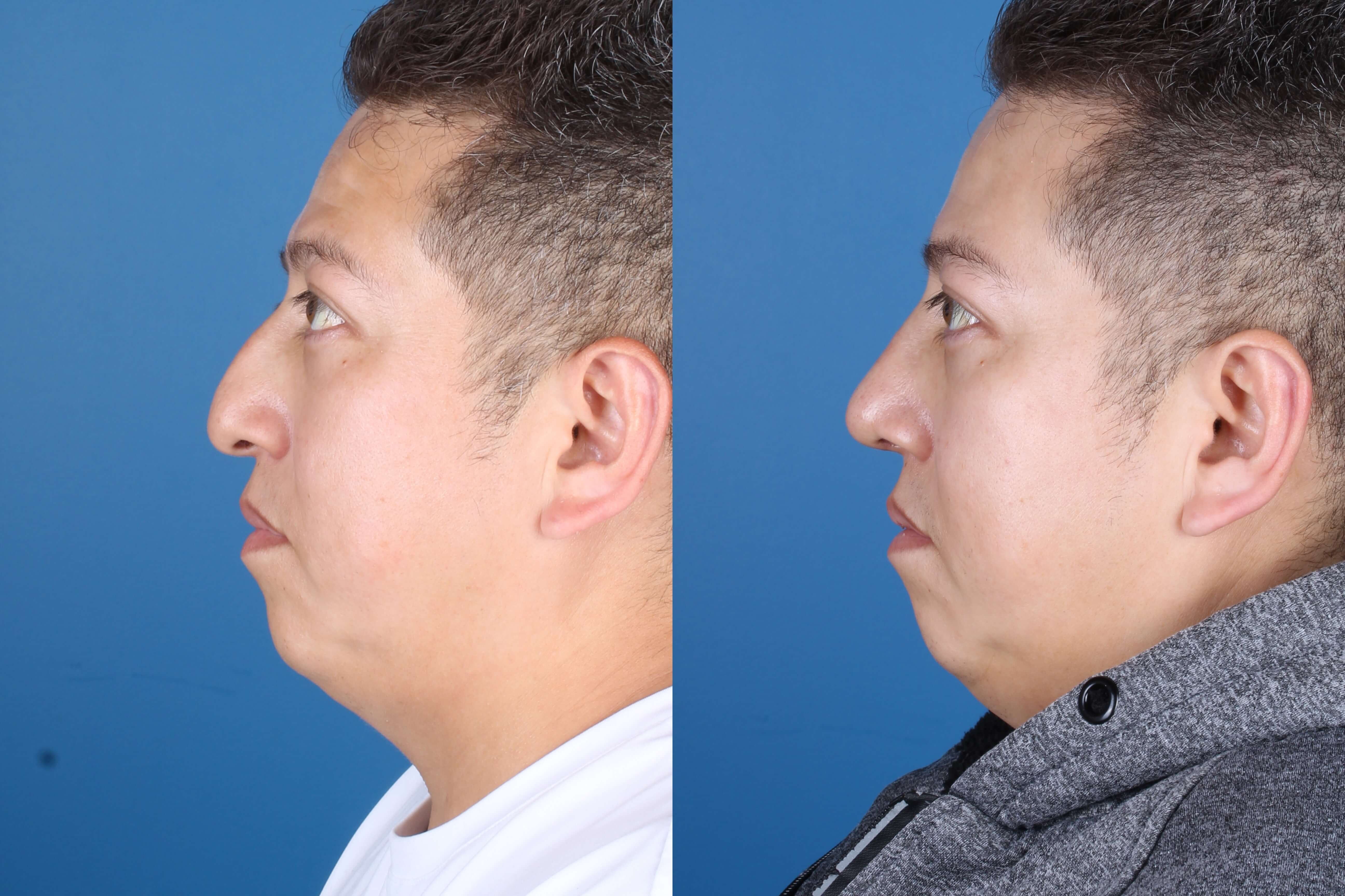 rhinoplasty-331-2 of 5