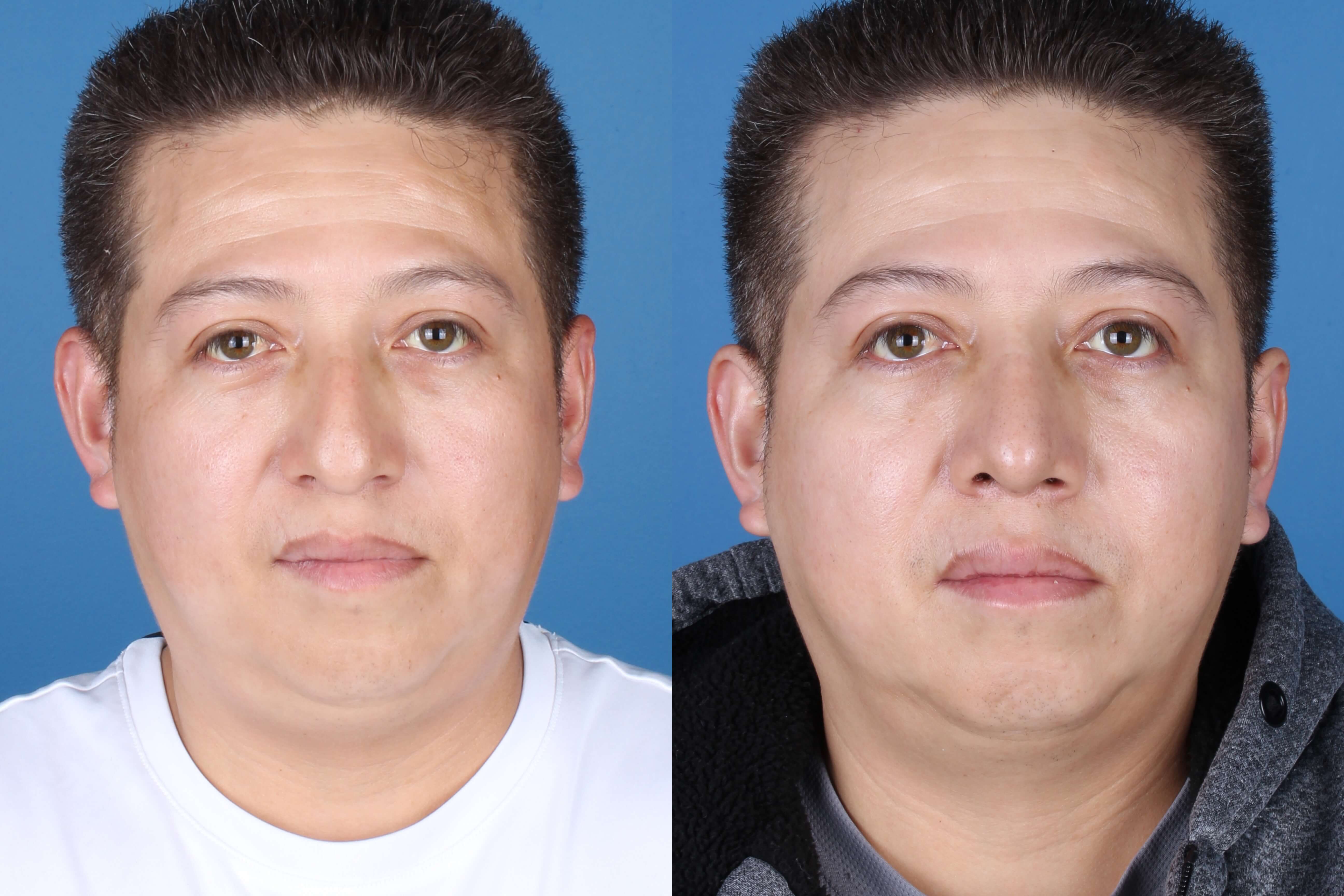 rhinoplasty-331-4 of 5