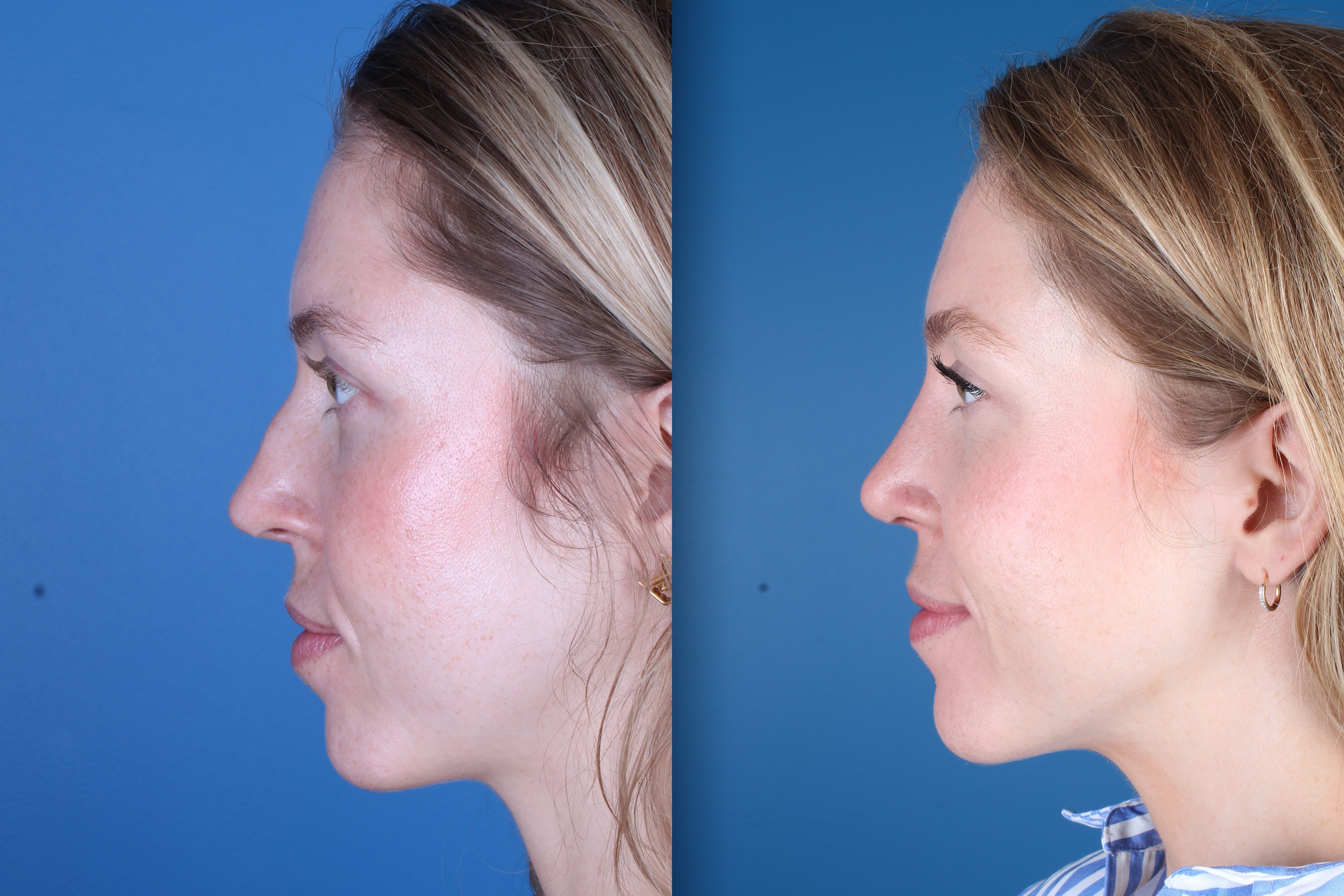 rhinoplasty-332-1 of 5