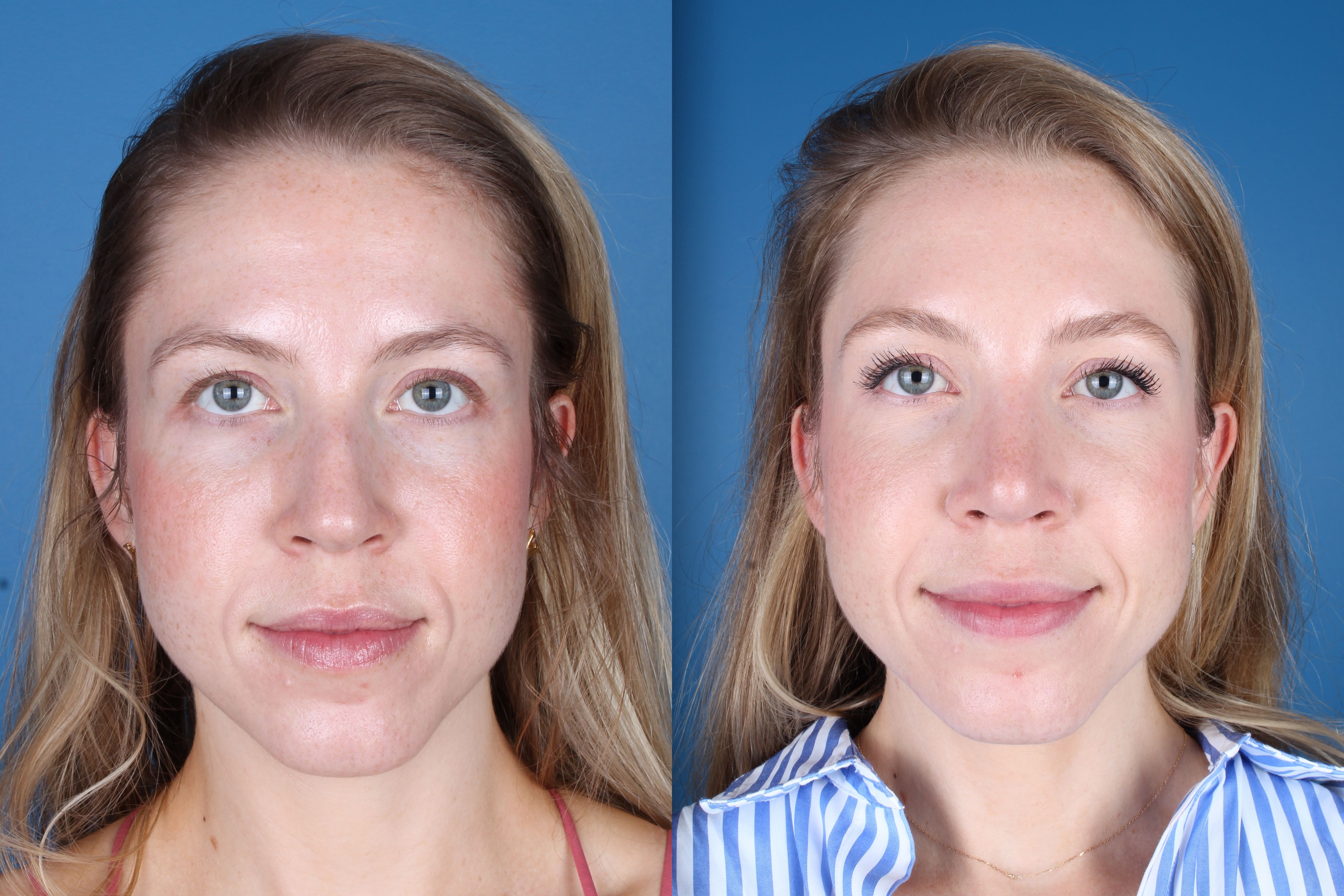 rhinoplasty-332-2 of 5