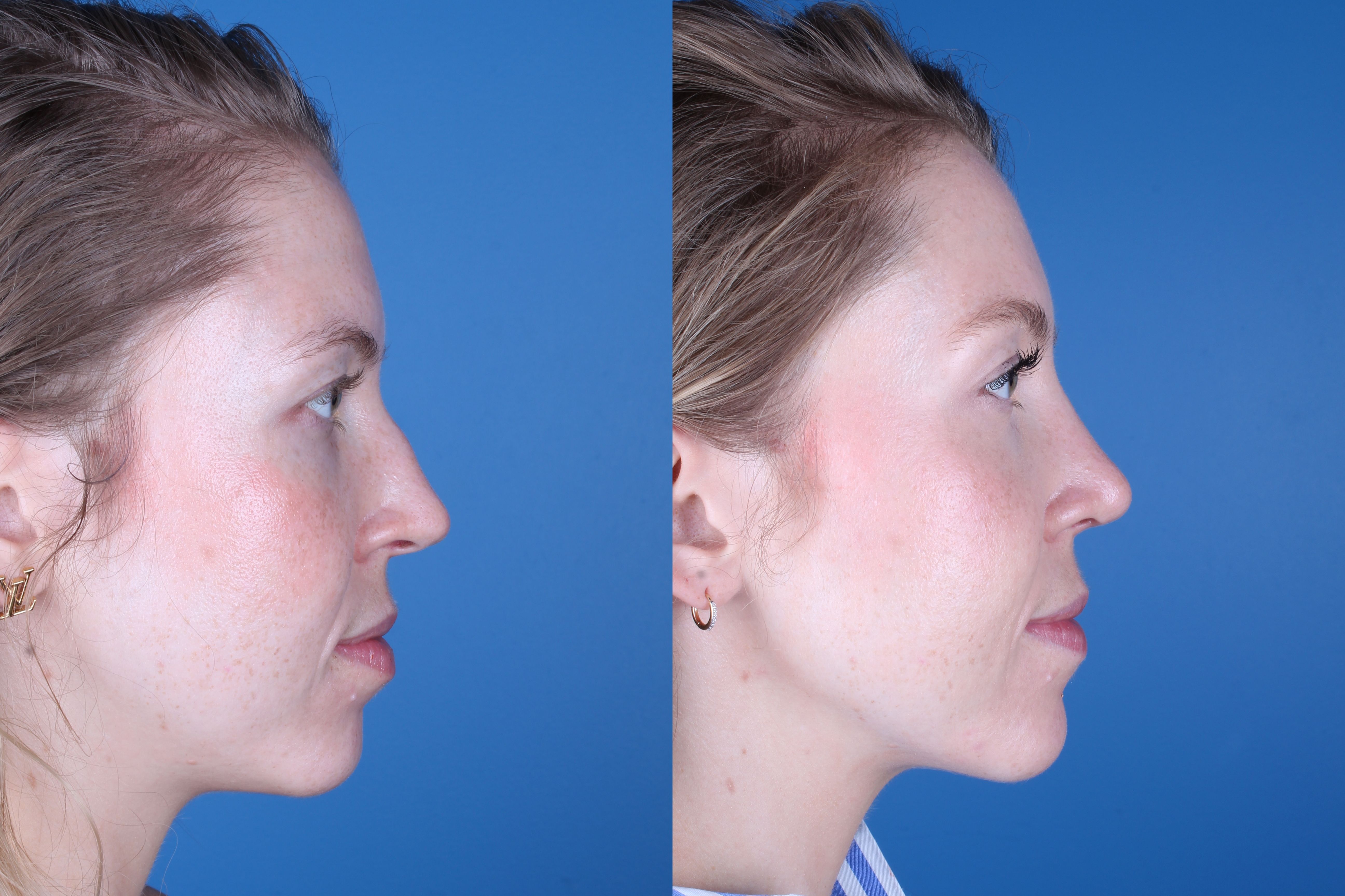 rhinoplasty-332-4 of 5