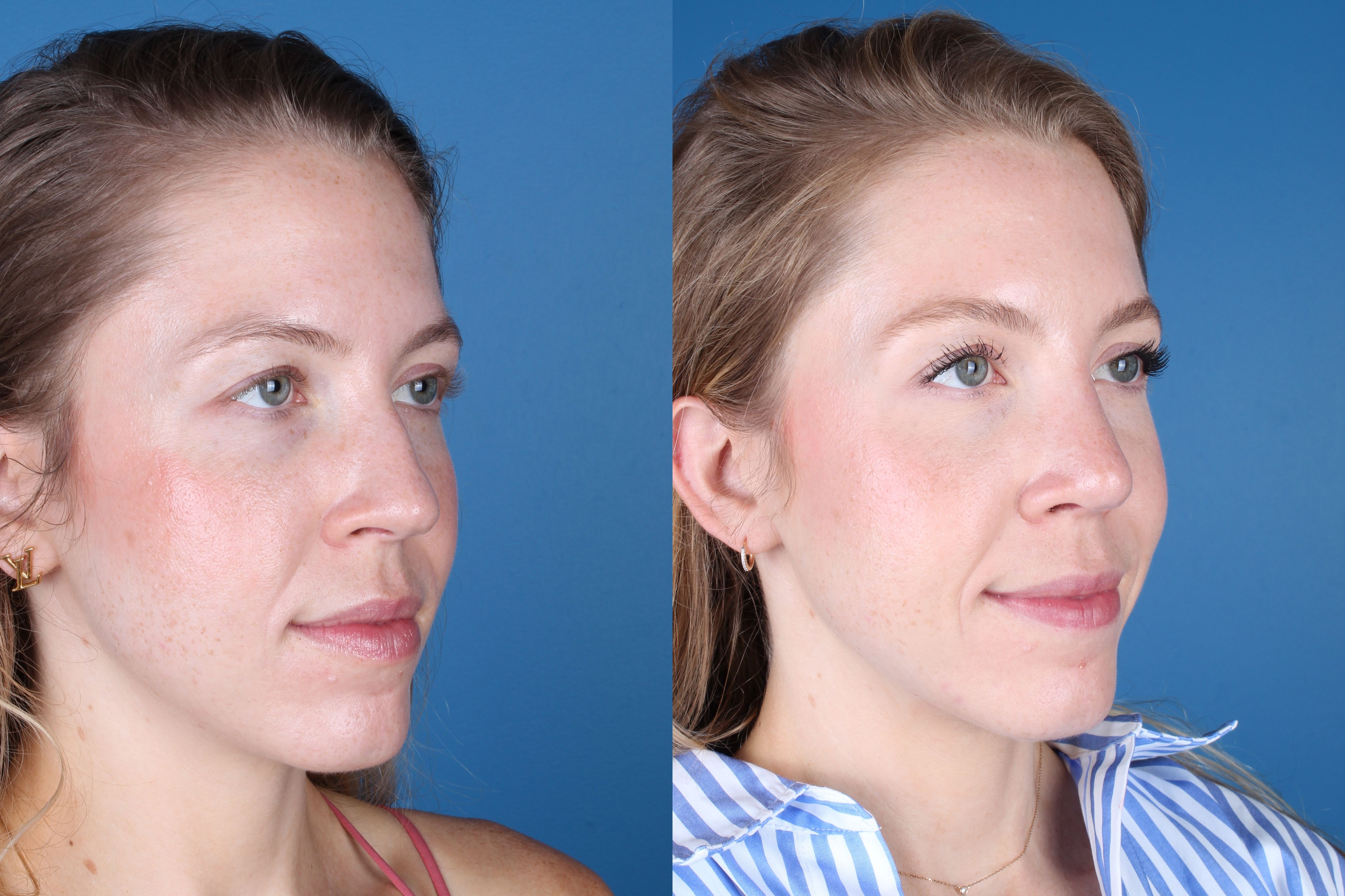 rhinoplasty-332-5 of 5