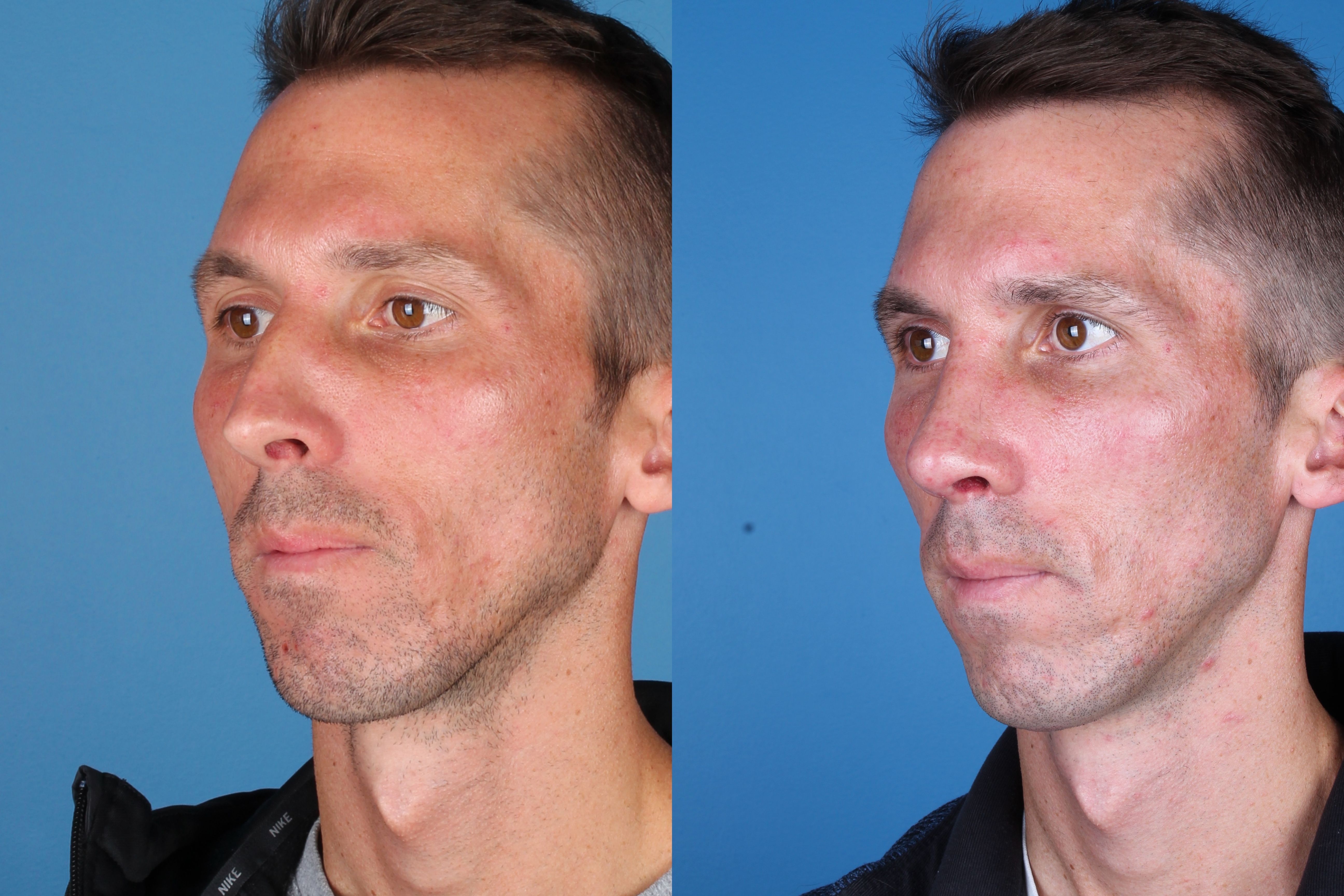 rhinoplasty-334-1 of 5