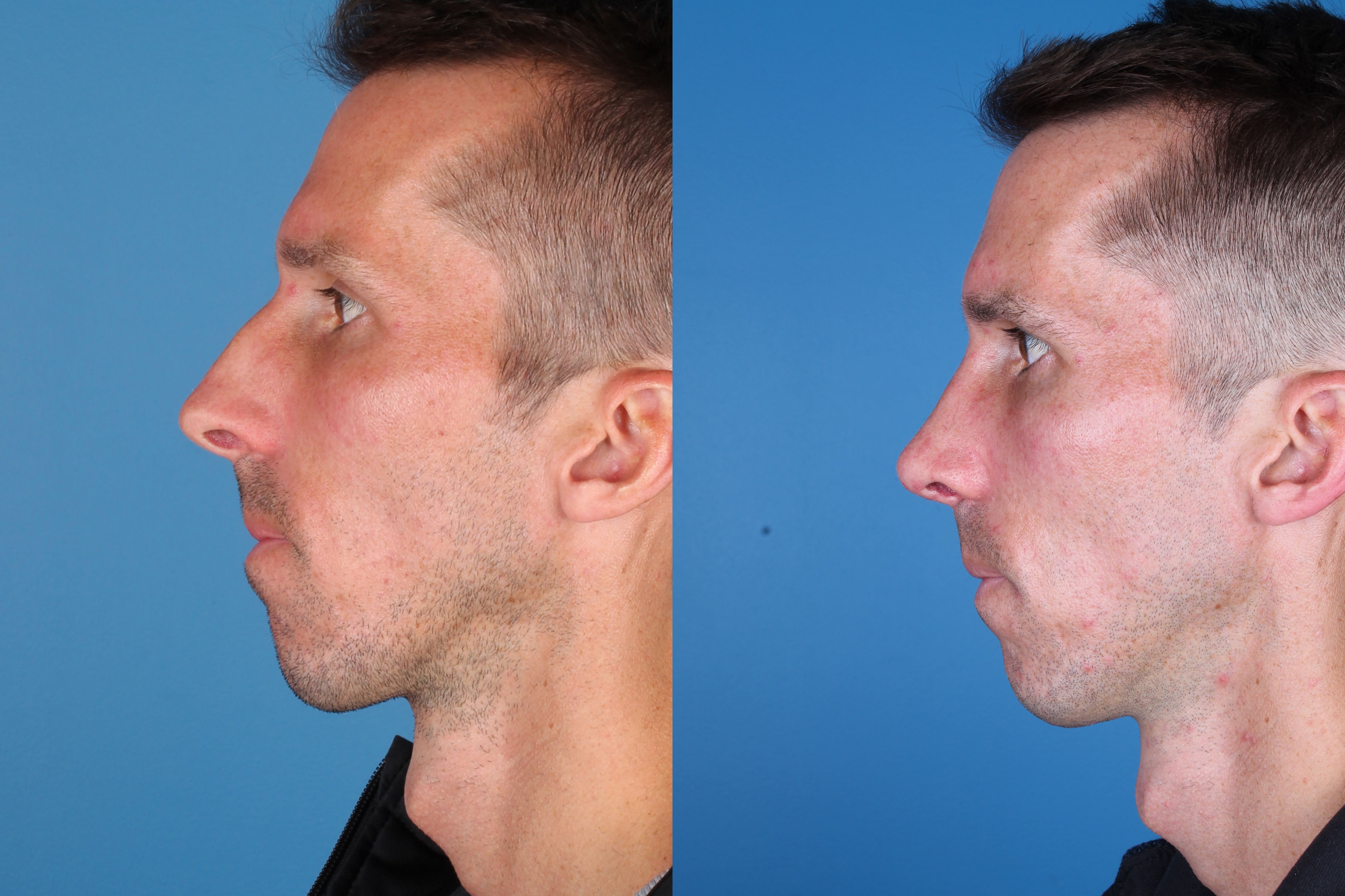 rhinoplasty-334-2 of 5