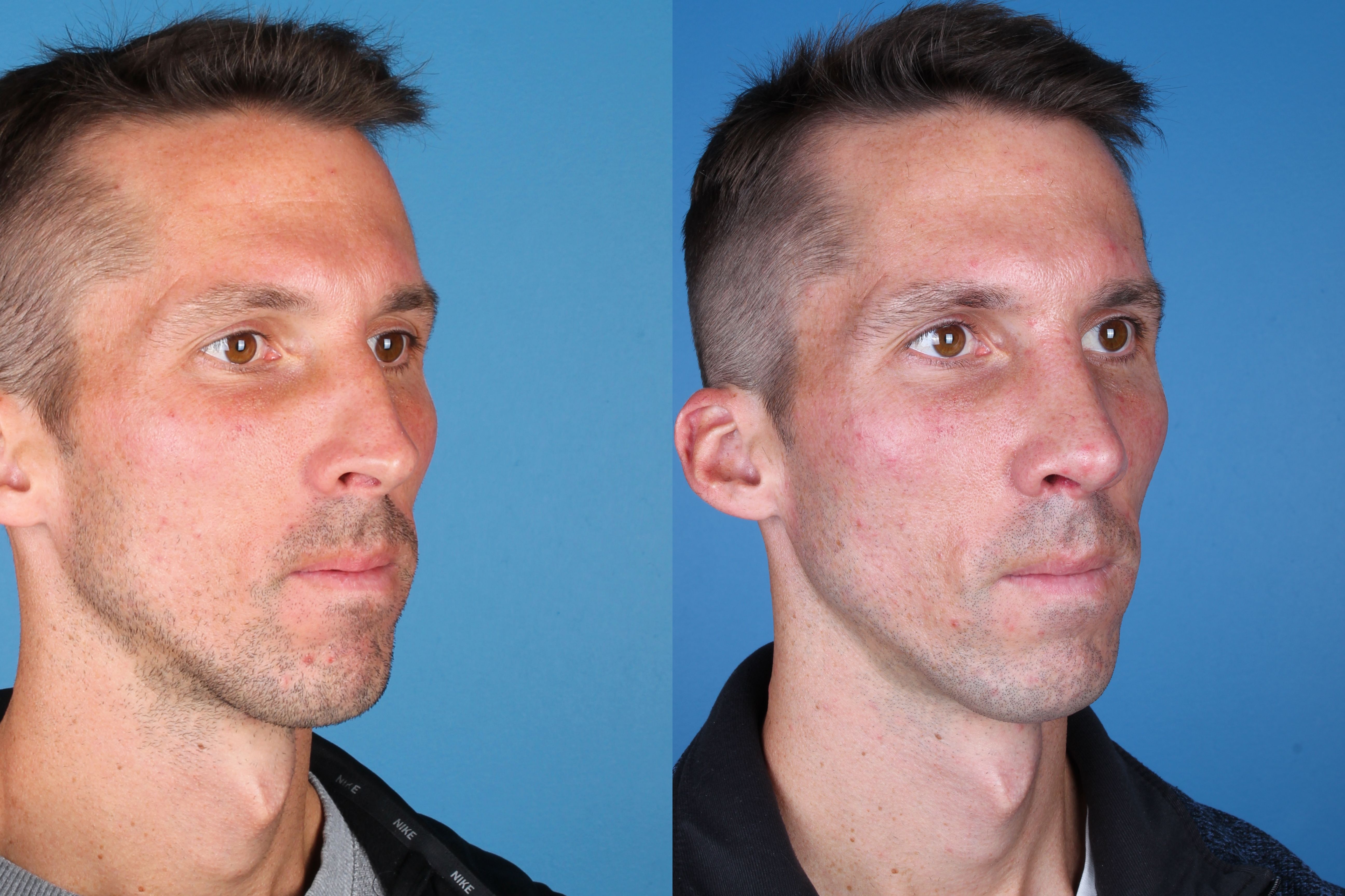 rhinoplasty-334-3 of 5