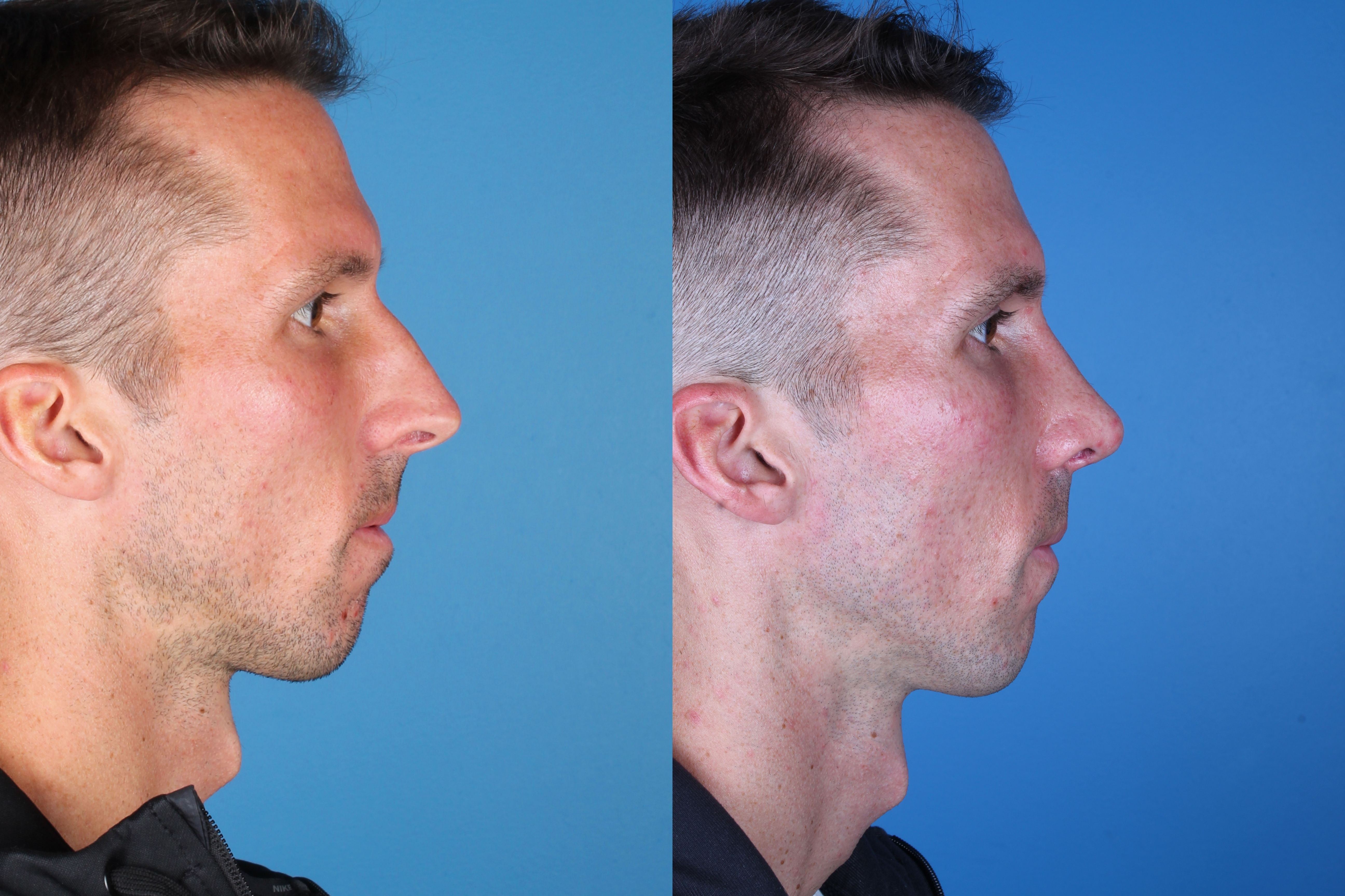 rhinoplasty-334-4 of 5