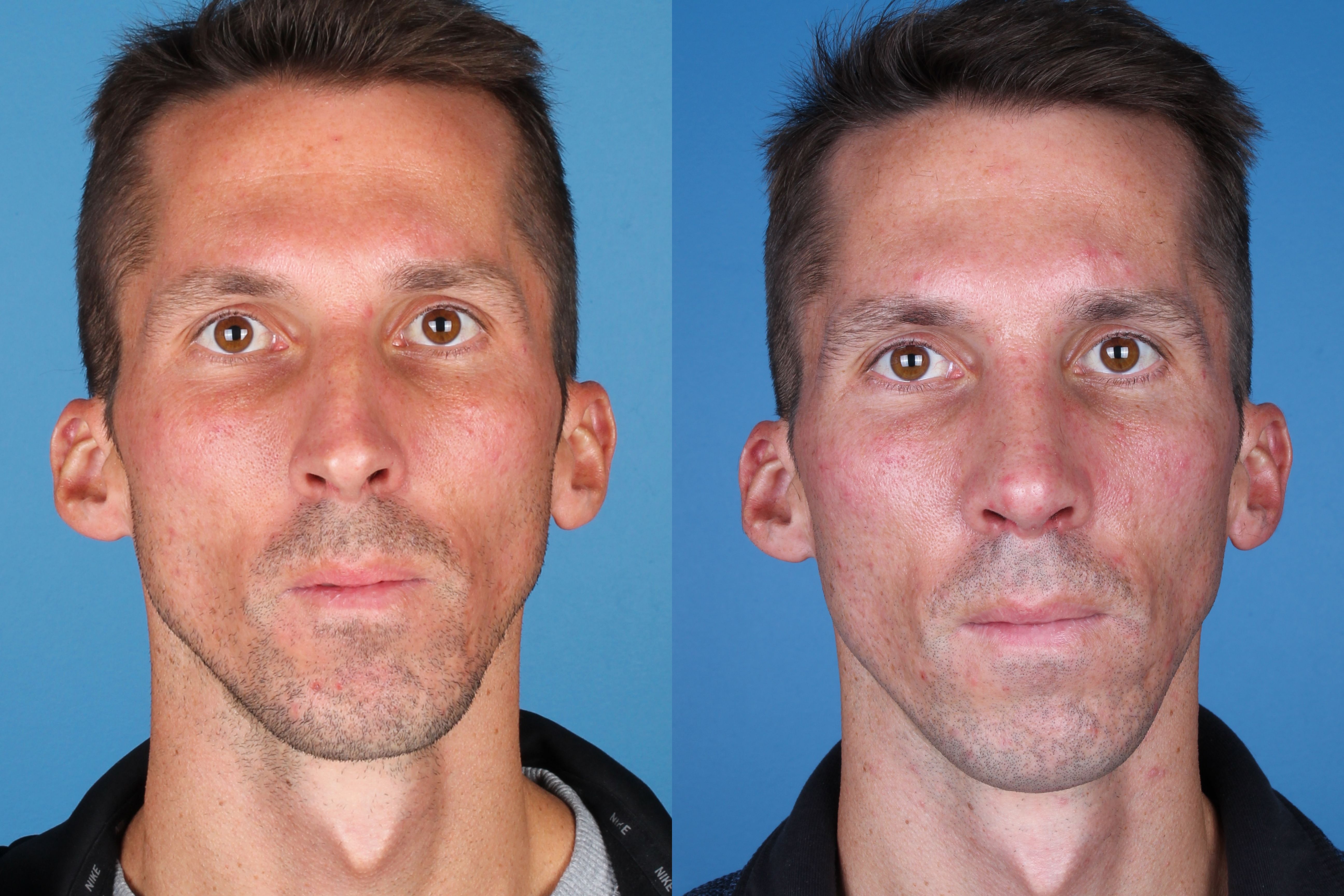 rhinoplasty-334-5 of 5