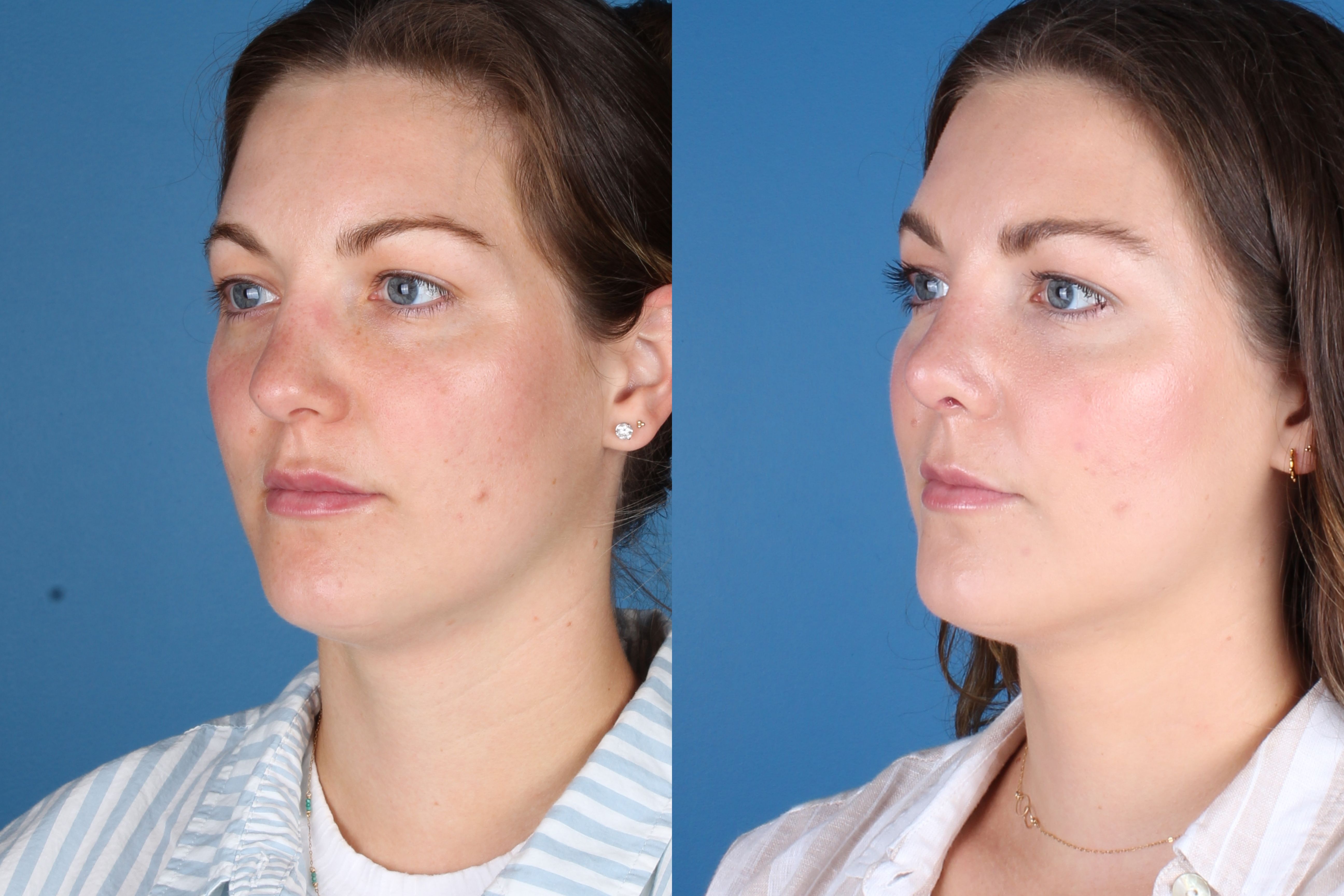 rhinoplasty-335-1 of 3