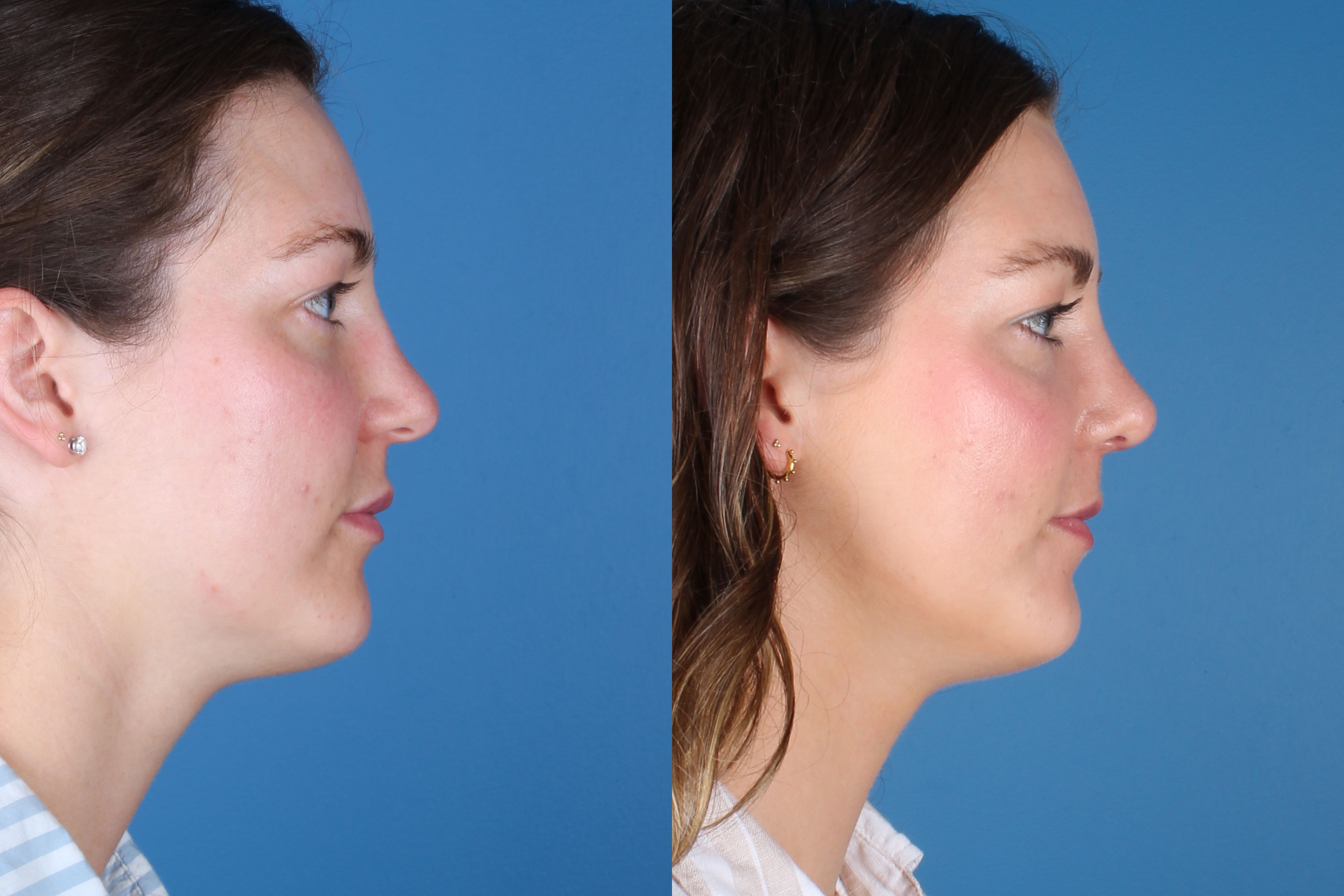 rhinoplasty-335-2 of 3