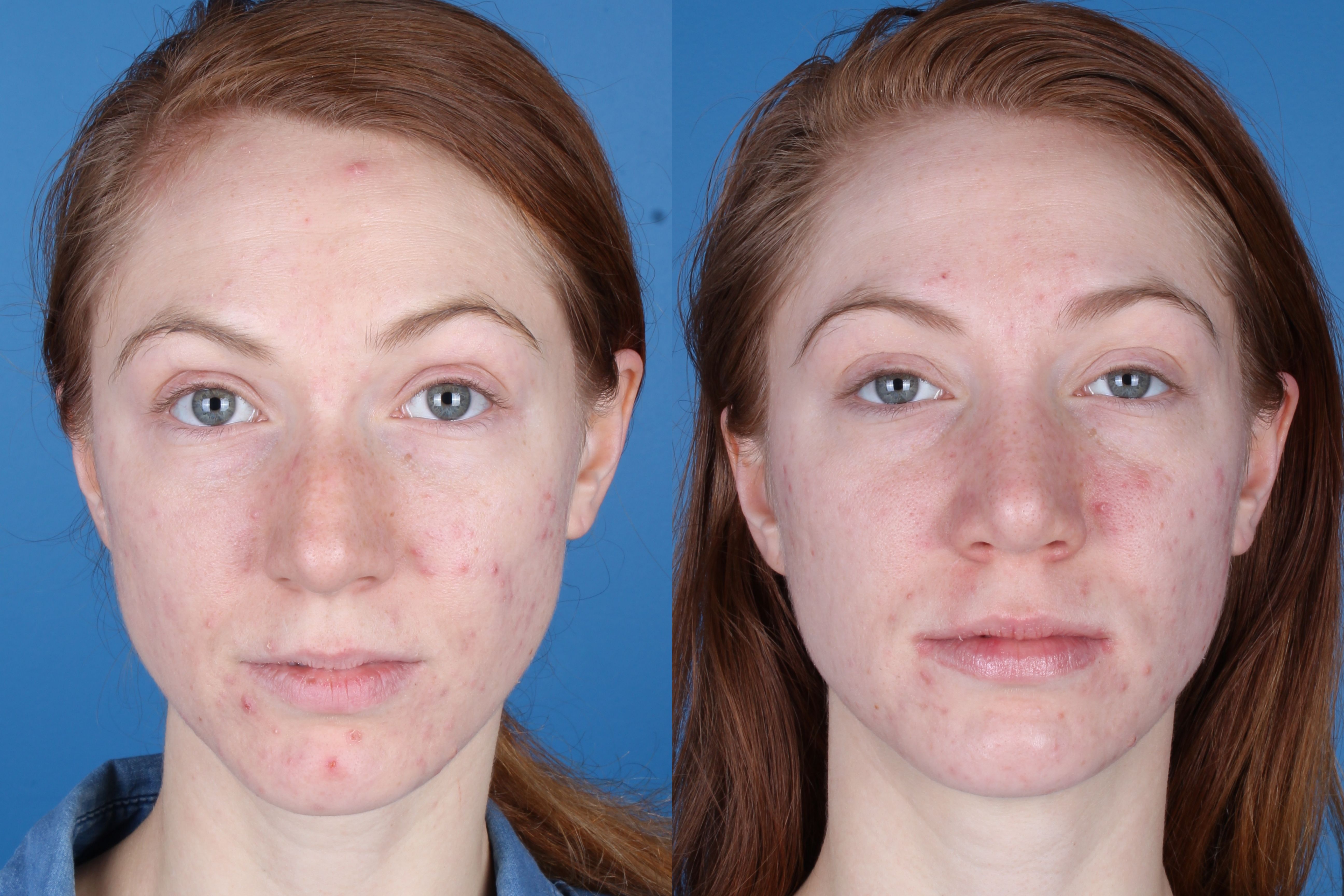 rhinoplasty-336-2 of 4