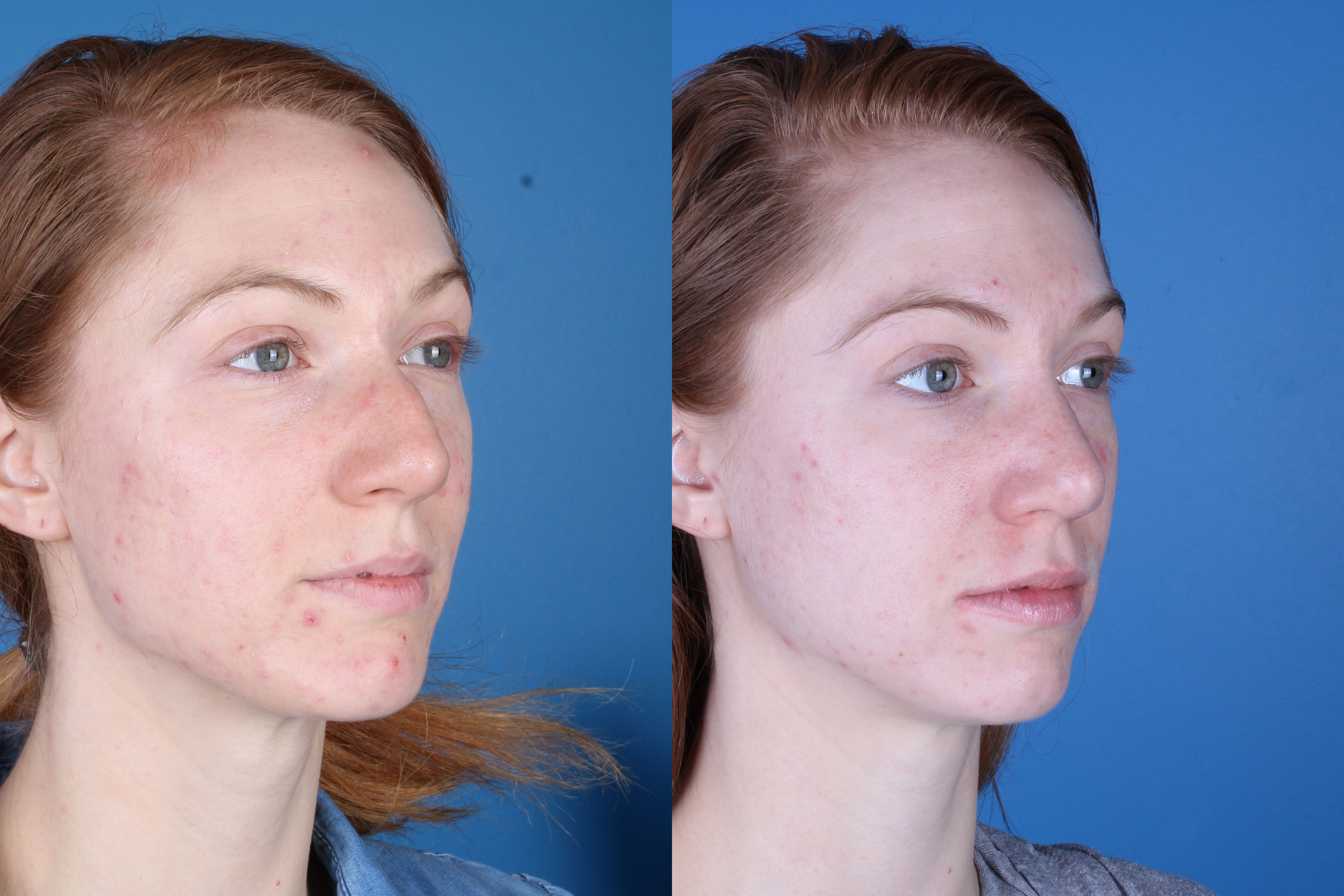 rhinoplasty-336-3 of 4