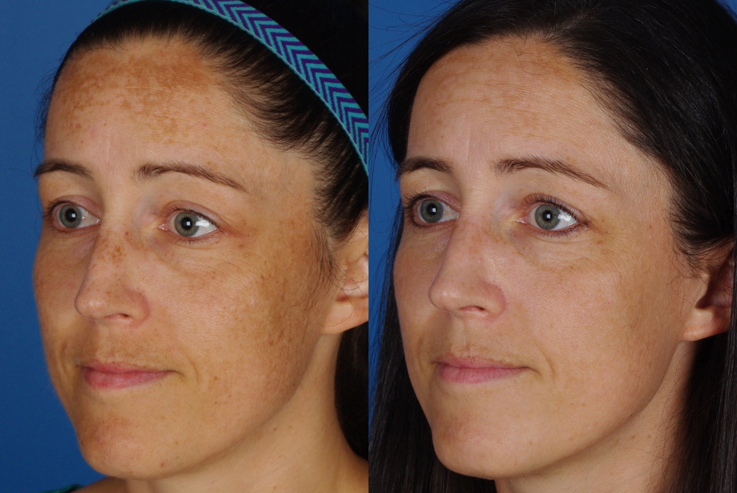 facial treatments-102-1 of 1